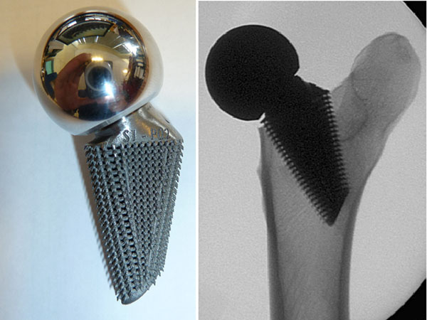 OsteoAnchor architecture applied to a short hip stem design (left); X-ray of device implanted in cadaver femur (right)