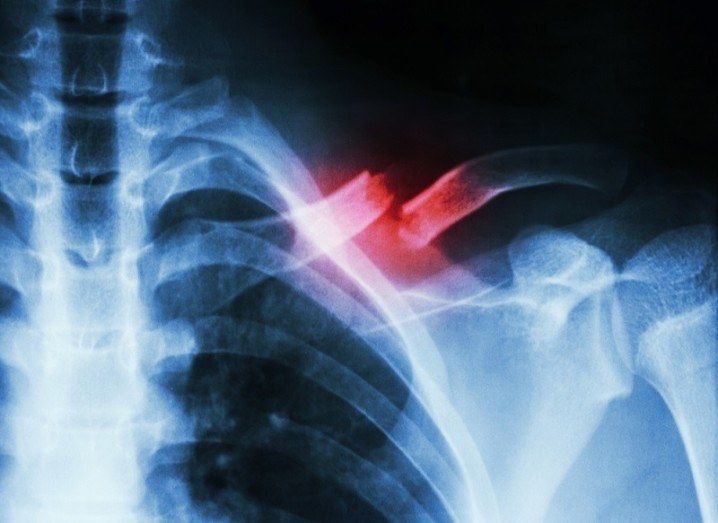 Broken bone x-ray