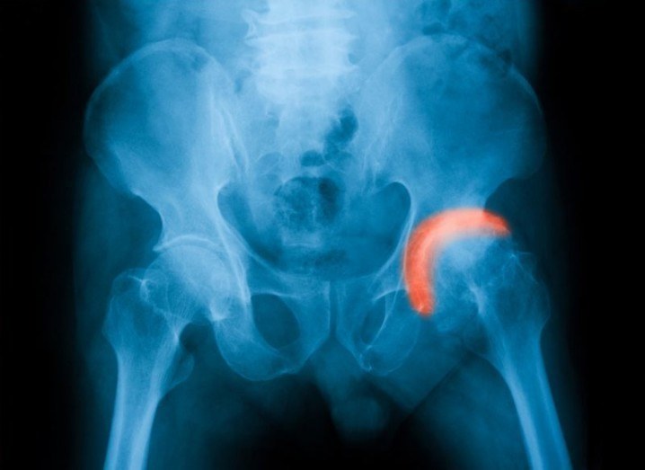 Hip fracture X-ray