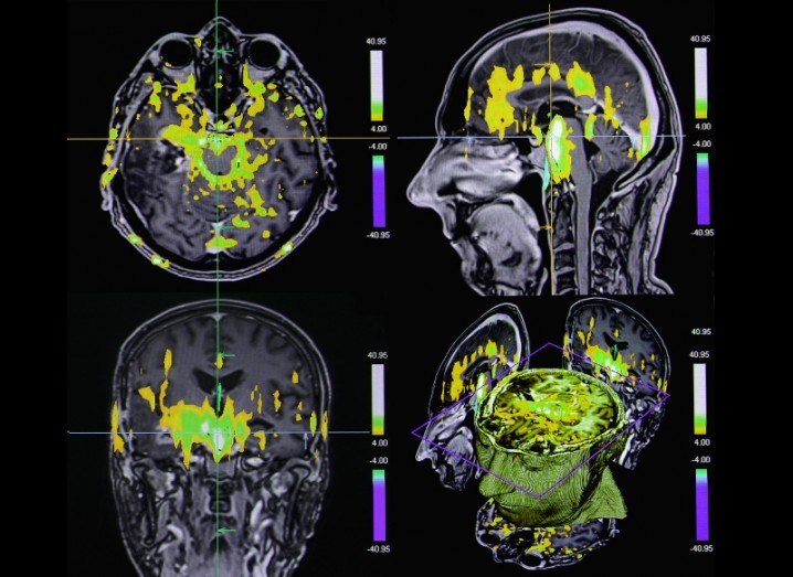Brain MRI scan