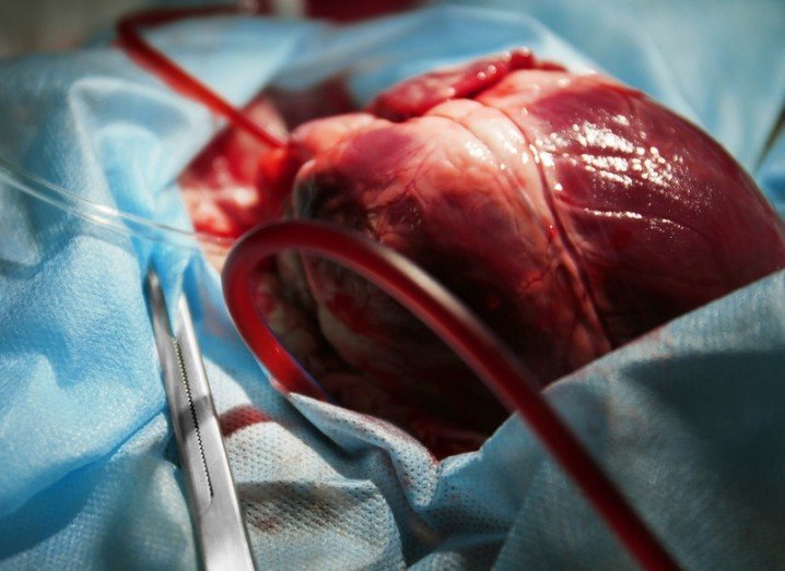 heart transplant stem cells