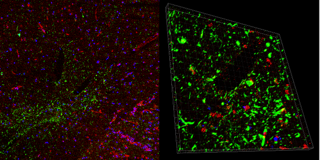 Left: Characteristic staining of p-Tau (green) in a case of CTE. Claudin-5 (red) protein levels are discontinuous and not present in areas of p-Tau accumulation around blood vessels. This is an indication of a dysfunctional blood brain barrier. Right: Areas of p-Tau (green) staining around blood vessels have absent or discontinuous claudin-5 (red) staining indicating a compromised blood brain barrier.