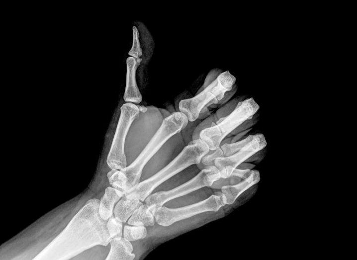 Bone graft x-ray