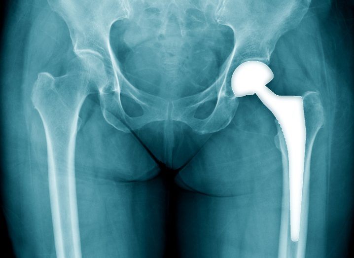 Graphene bone implant