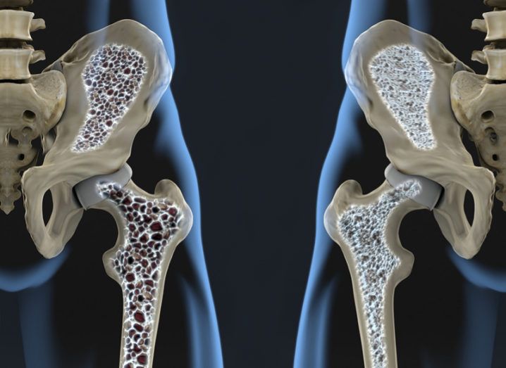 Osteoporosis test developed at UL to benefit millions of people