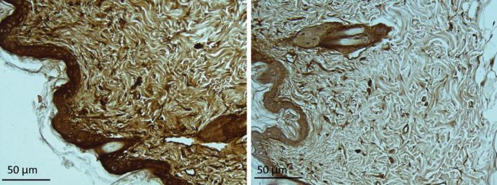 Huntingtin aggregates (brown) are elevated in skin sections from HD model mice (left). Levels are reduced after treatment with P110 (right). Image: Disatnik et al., 2016