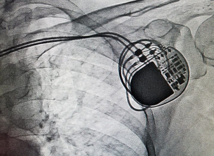 FDA warns hackers can attack pacemakers and kill patients
