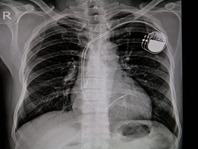 Pacemaker implant