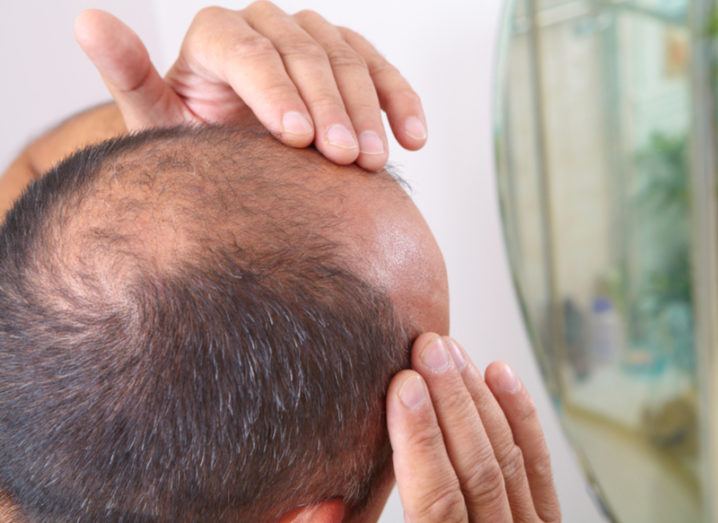 Cure for baldness? Unlikely drug discovery shows amazing promise