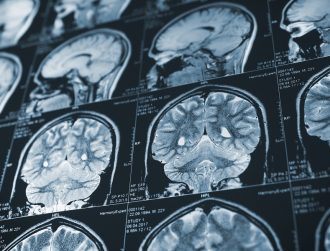 US approves Alzheimer’s drug designed to slow cognitive decline