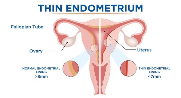 Chart of a female reproductive system showing the difference between an average endometrial lining of more than 8mm and a thin endometrial lining of less than 7mm.