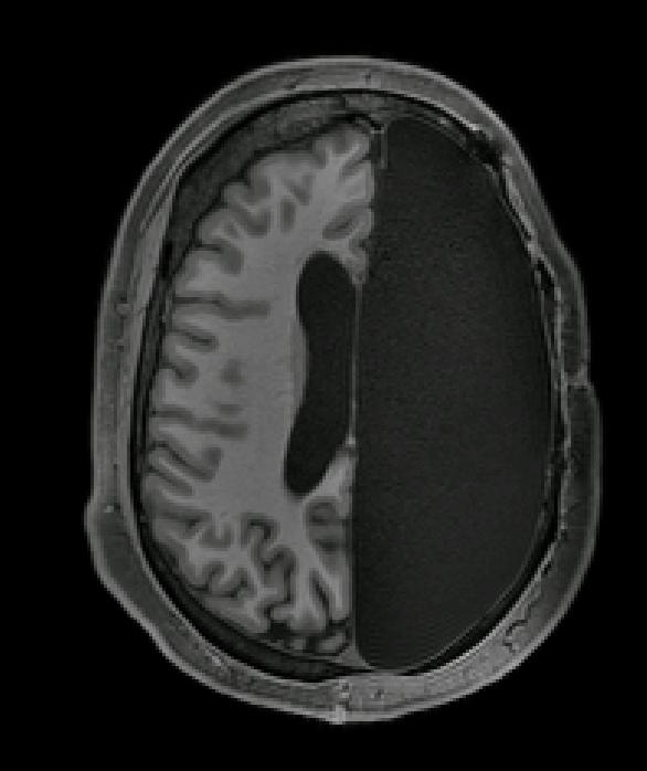 FMRI image of a brain scan with someone who had a hemispherectomy. 