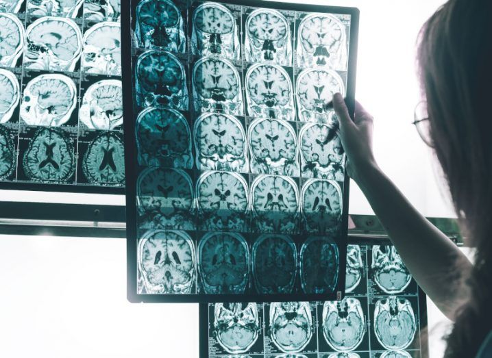 A medical worker looking at brain scans of patients with Alzheimer's disease.