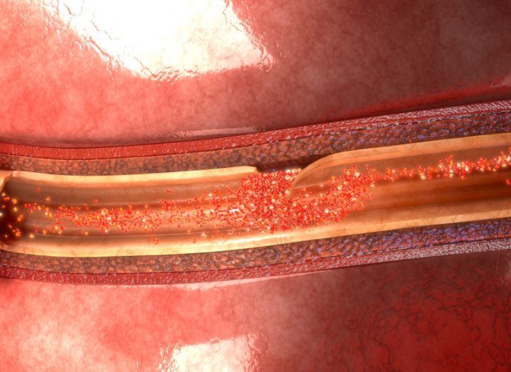 Illustration of an artery with a gap near the top, with blood cells moving toward the gap.