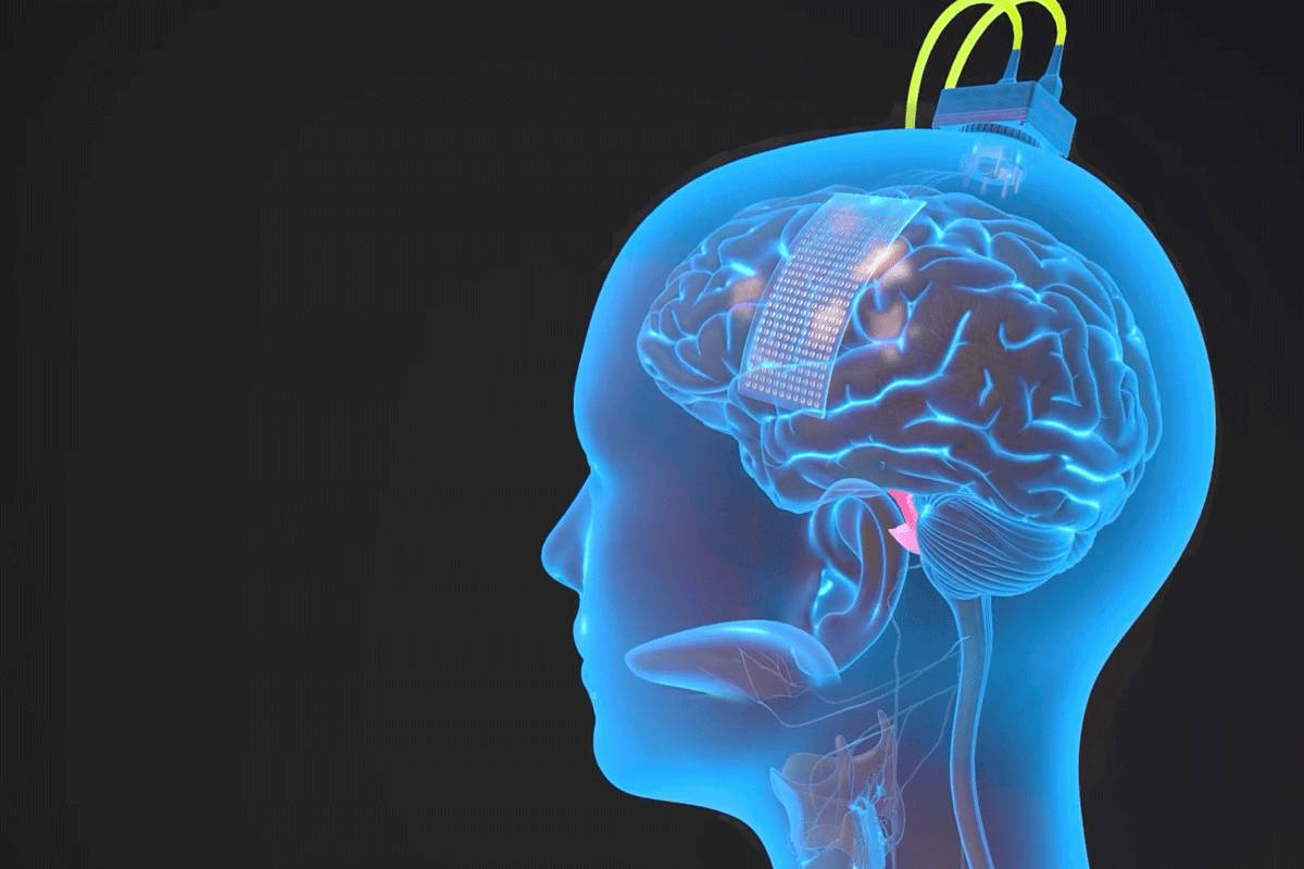 Illustration of a person's head in blue lighting, with a cable on the top of the head and a rectangular device on the side of the brain.